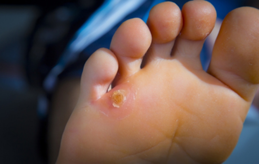 Corn on shops edge of foot